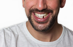 A male patient has lost his front tooth